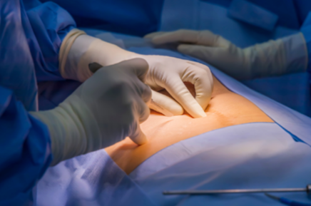 Rusted Hernia Surgeon in Dubai and General Surgeon in Dubai for Effective Surgical Care